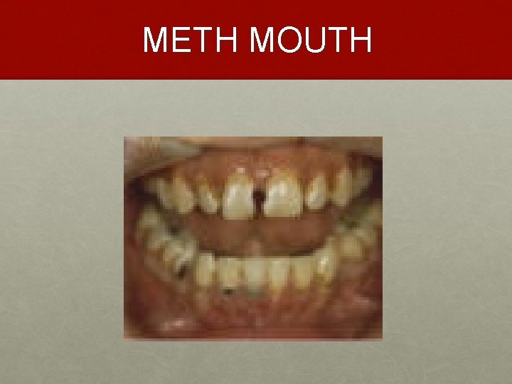 METH MOUTH 