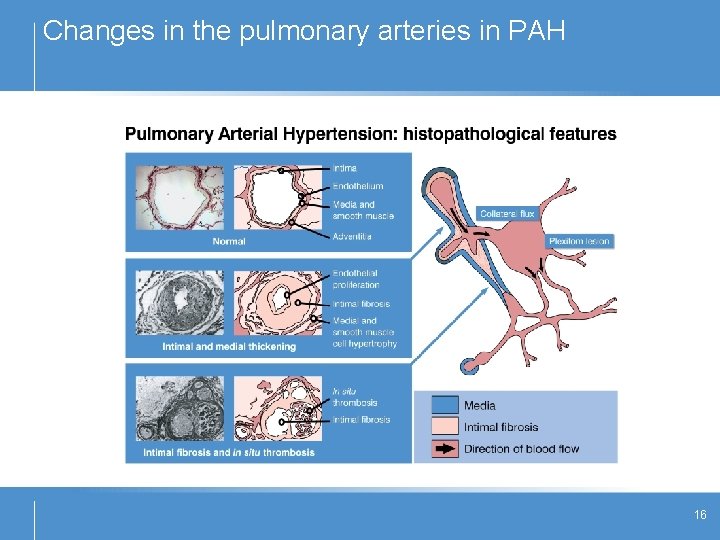 Changes in the pulmonary arteries in PAH 16 