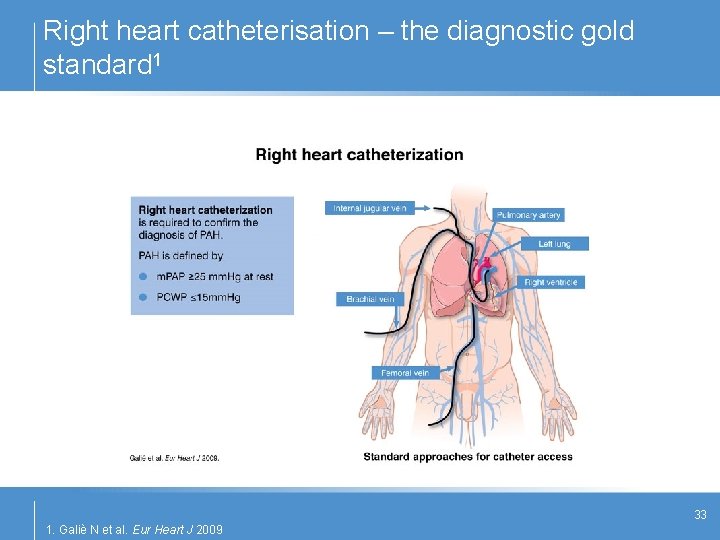 Right heart catheterisation – the diagnostic gold standard 1 33 1. Galiè N et