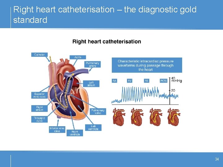 Right heart catheterisation – the diagnostic gold standard 34 