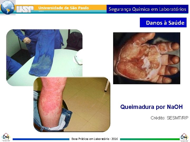 Segurança Química em Laboratórios Danos à Saúde Queimadura por Na. OH Crédito: SESMT/RP Boas