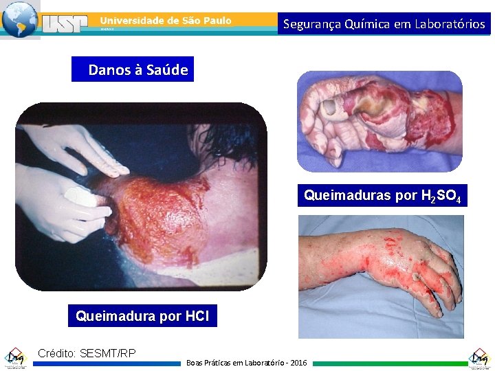 Segurança Química em Laboratórios Danos à Saúde Queimaduras por H 2 SO 4 Queimadura