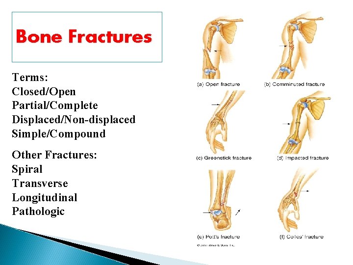 Bone Fractures Terms: Closed/Open Partial/Complete Displaced/Non-displaced Simple/Compound Other Fractures: Spiral Transverse Longitudinal Pathologic 