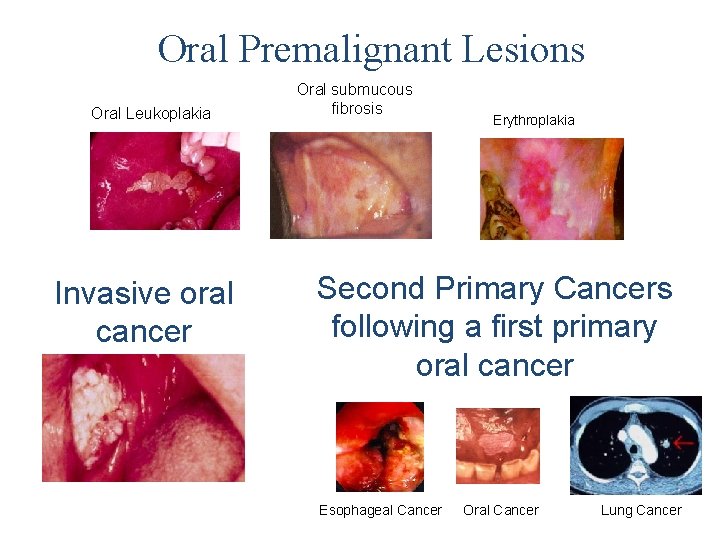 Oral Premalignant Lesions Oral Leukoplakia Invasive oral cancer Oral submucous fibrosis Erythroplakia Second Primary