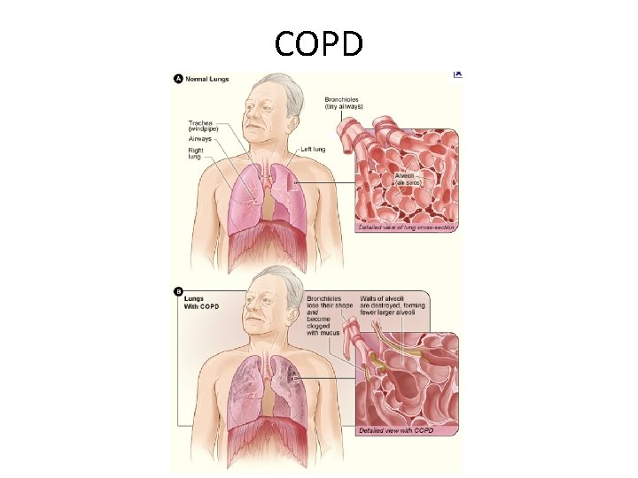 COPD 