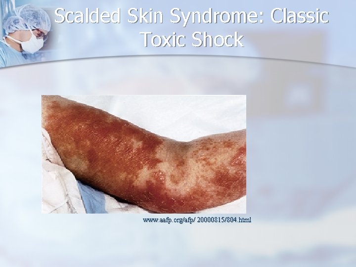 Scalded Skin Syndrome: Classic Toxic Shock www. aafp. org/afp/ 20000815/804. html 