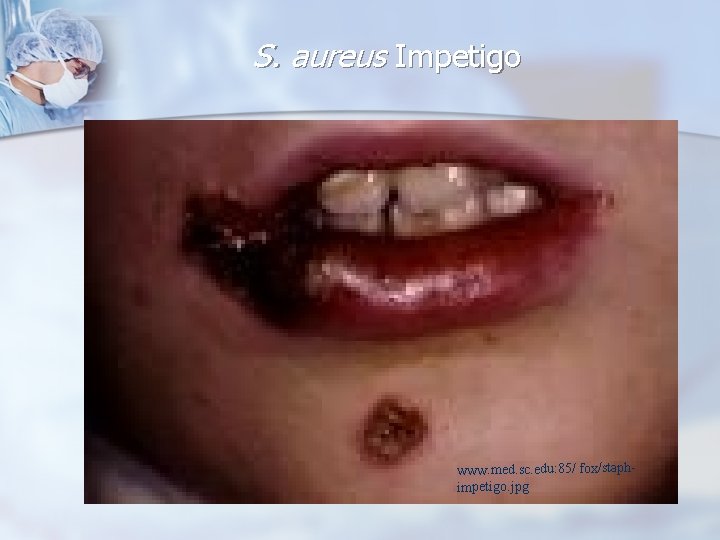 S. aureus Impetigo www. med. sc. edu: 85/ fox/staphimpetigo. jpg 