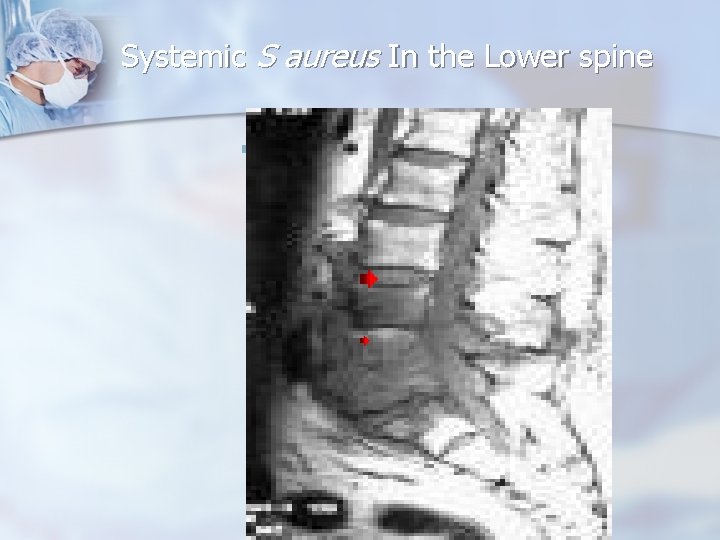 Systemic S aureus In the Lower spine n . 