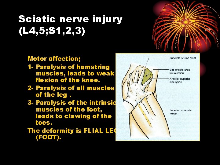Sciatic nerve injury (L 4, 5; S 1, 2, 3) Motor affection; 1 -