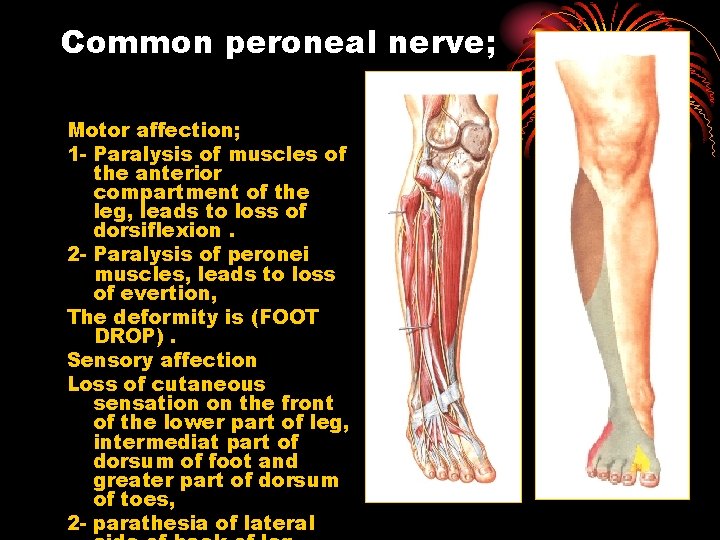 Common peroneal nerve; Motor affection; 1 - Paralysis of muscles of the anterior compartment