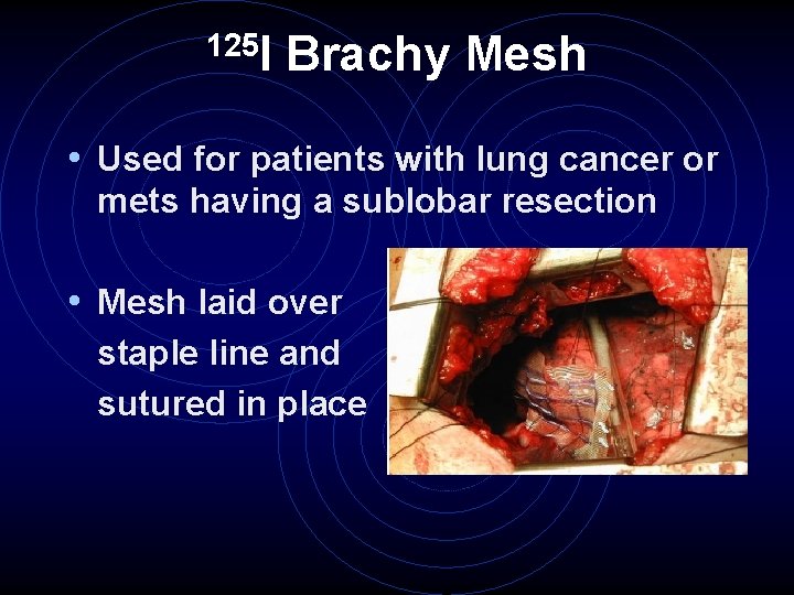 125 I Brachy Mesh • Used for patients with lung cancer or mets having