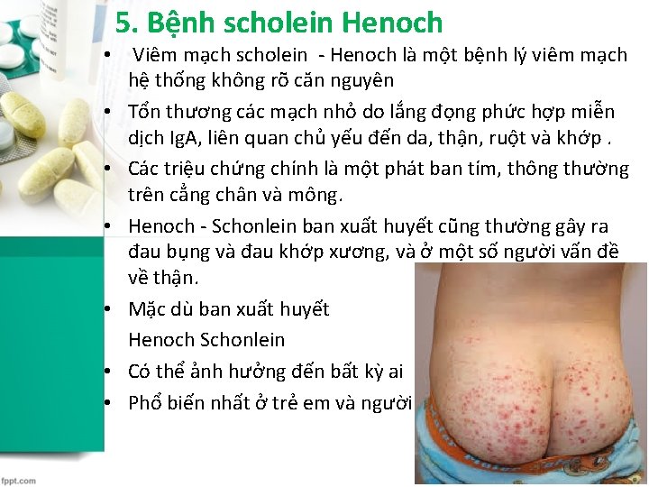 5. Bệnh scholein Henoch • Viêm mạch scholein - Henoch là một bệnh lý