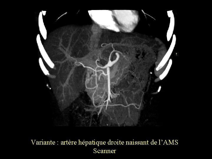 Variante : artère hépatique droite naissant de l’AMS Scanner 