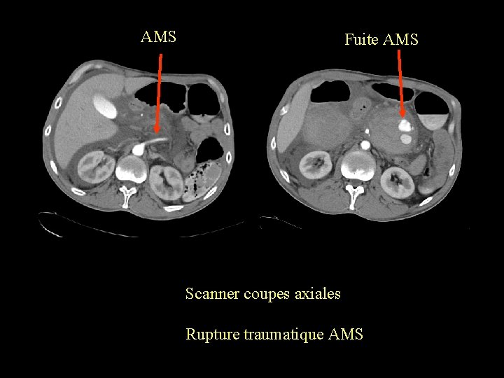 AMS Fuite AMS Scanner coupes axiales Rupture traumatique AMS 