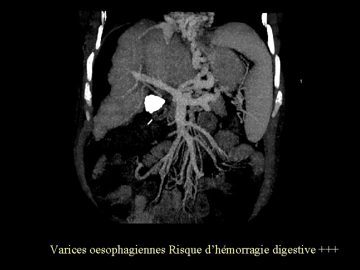 Varices oesophagiennes Risque d’hémorragie digestive +++ 