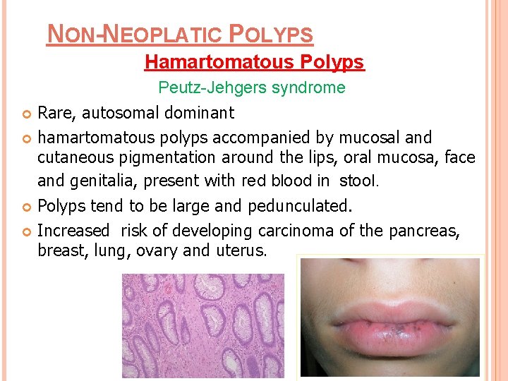 NON-NEOPLATIC POLYPS Hamartomatous Polyps Peutz-Jehgers syndrome Rare, autosomal dominant hamartomatous polyps accompanied by mucosal