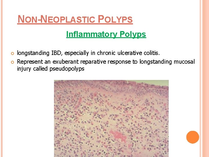 NON-NEOPLASTIC POLYPS Inflammatory Polyps longstanding IBD, especially in chronic ulcerative colitis. Represent an exuberant