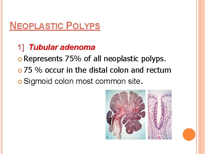 NEOPLASTIC POLYPS 1] Tubular adenoma Represents 75% of all neoplastic polyps. 75 % occur