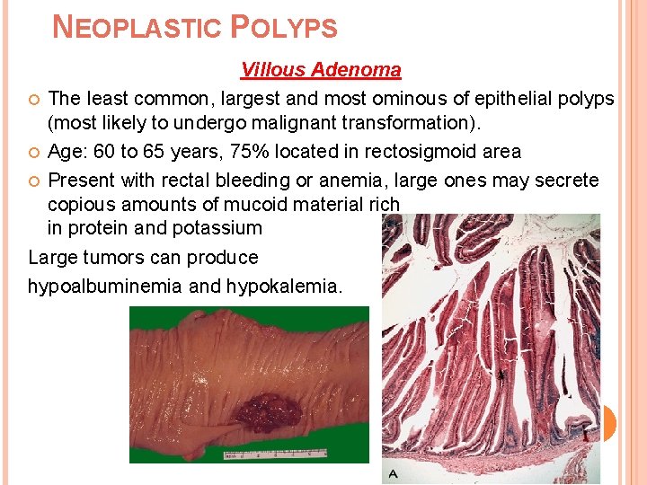 NEOPLASTIC POLYPS Villous Adenoma The least common, largest and most ominous of epithelial polyps