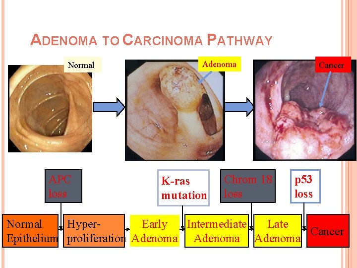 ADENOMA TO CARCINOMA PATHWAY Normal APC loss Adenoma K-ras mutation Chrom 18 loss Cancer