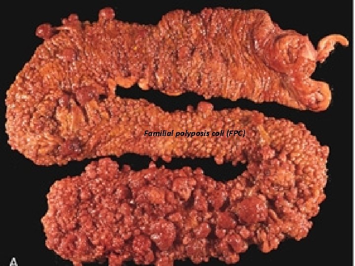Familial polyposis coli (FPC) 