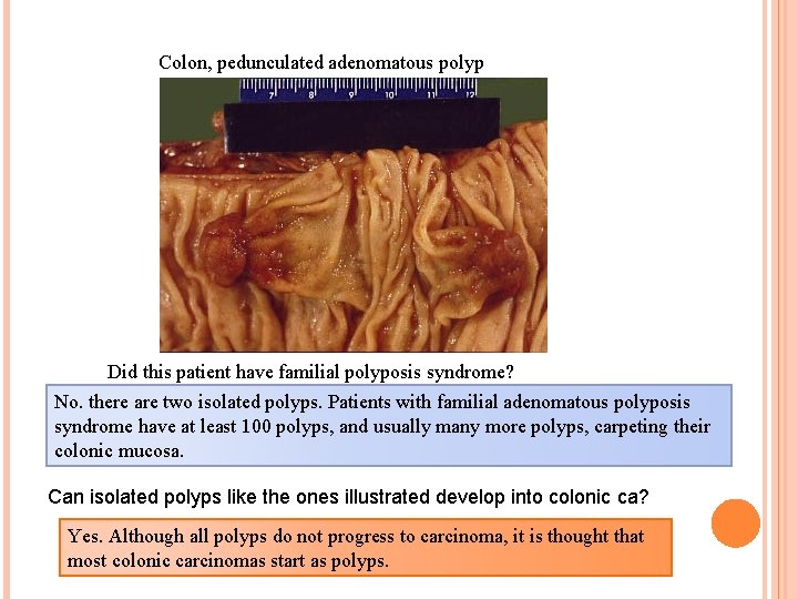 Colon, pedunculated adenomatous polyp Did this patient have familial polyposis syndrome? No. there are