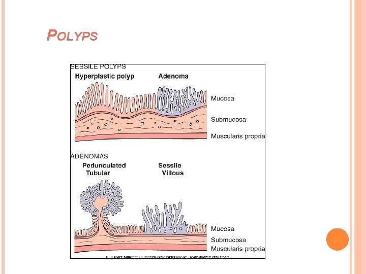 POLYPS 