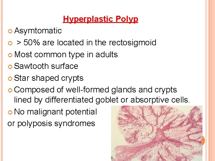  Hyperplastic Polyp Asymtomatic > 50% are located in the rectosigmoid Most common type