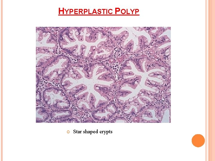 HYPERPLASTIC POLYP Star shaped crypts 