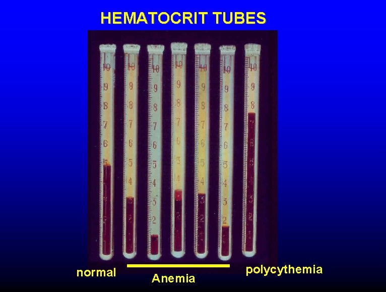 HEMATOCRIT TUBES normal Anemia polycythemia 