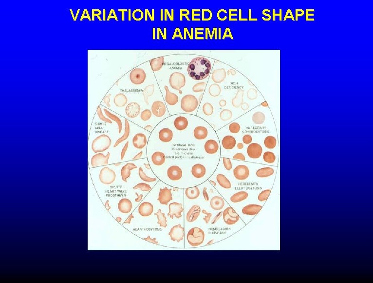 VARIATION IN RED CELL SHAPE IN ANEMIA 