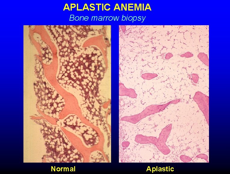 APLASTIC ANEMIA Bone marrow biopsy Normal Aplastic 