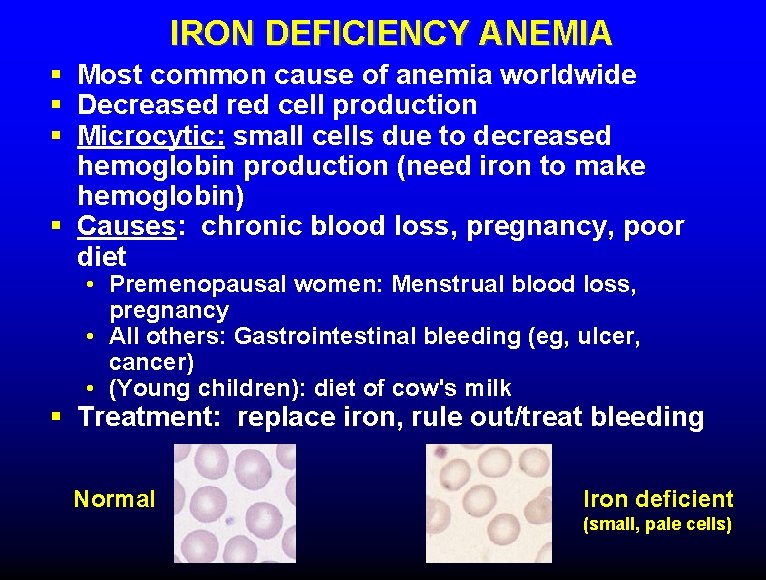 IRON DEFICIENCY ANEMIA § Most common cause of anemia worldwide § Decreased red cell