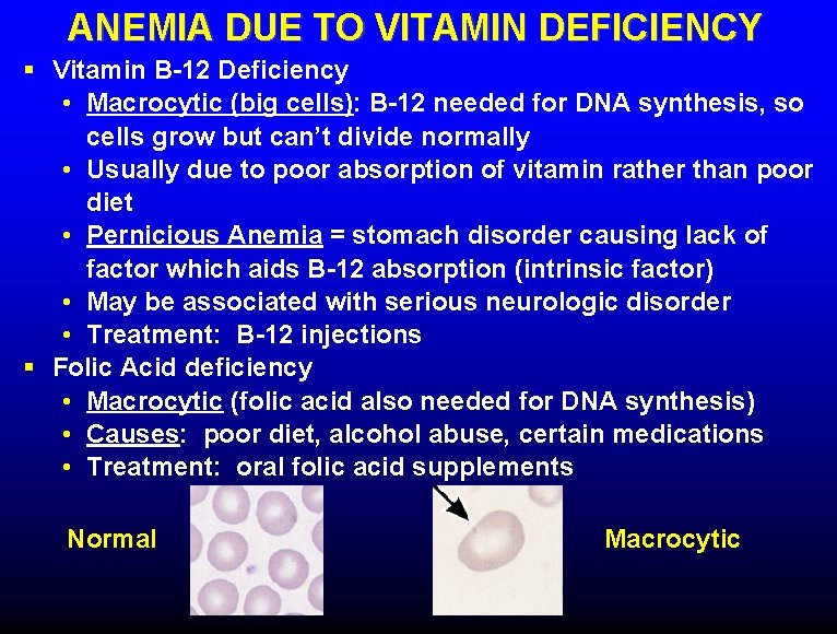 ANEMIA DUE TO VITAMIN DEFICIENCY § Vitamin B-12 Deficiency • Macrocytic (big cells): B-12