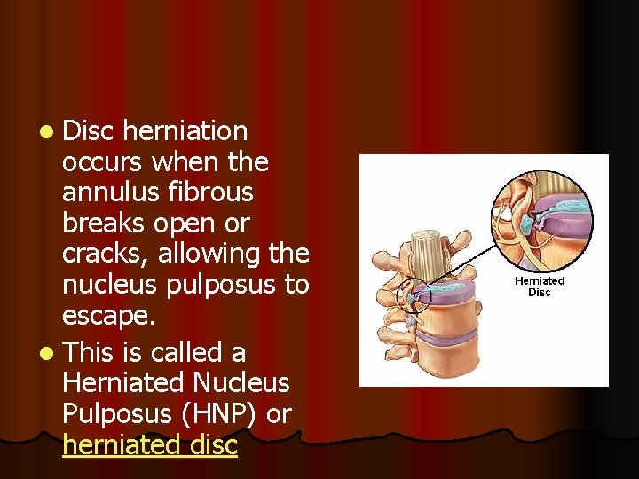 l Disc herniation occurs when the annulus fibrous breaks open or cracks, allowing the