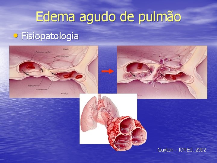 Edema agudo de pulmão • Fisiopatologia Guyton - 10ª Ed. 2002 
