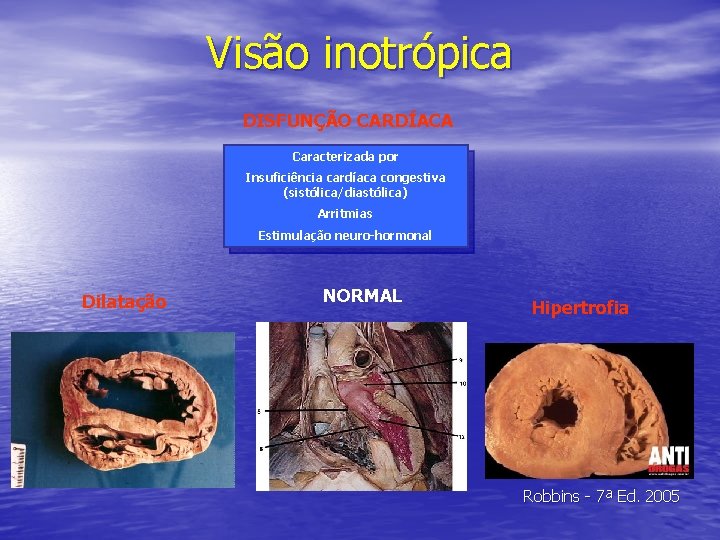 Visão inotrópica DISFUNÇÃO CARDÍACA Caracterizada por Insuficiência cardíaca congestiva (sistólica/diastólica) Arritmias Estimulação neuro-hormonal Dilatação