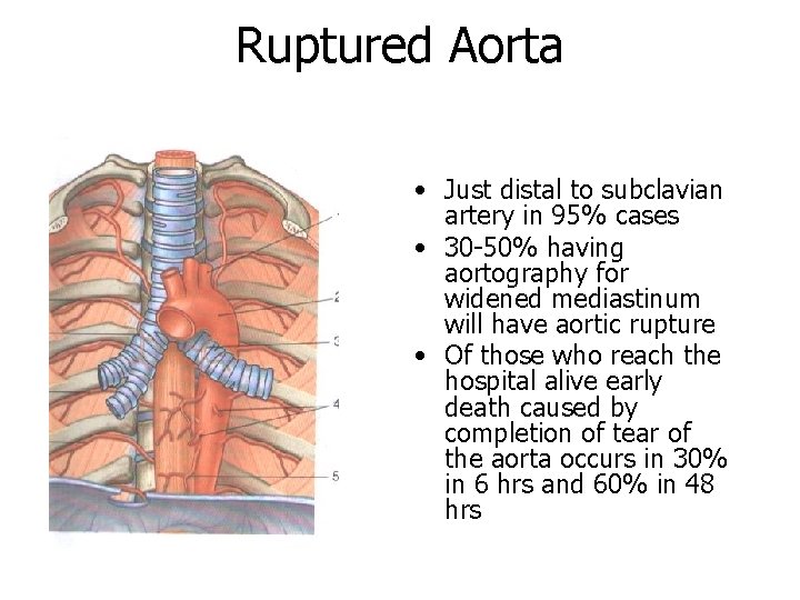 Ruptured Aorta • Just distal to subclavian artery in 95% cases • 30 -50%