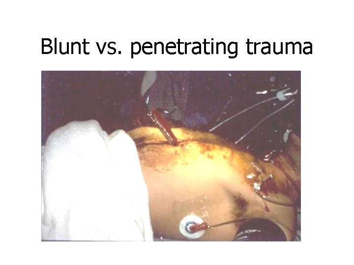 Blunt vs. penetrating trauma 