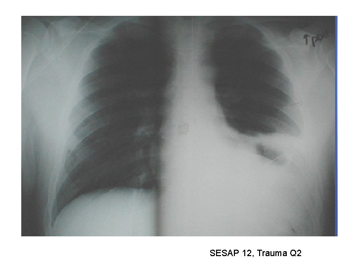 SESAP 12, Trauma Q 2 