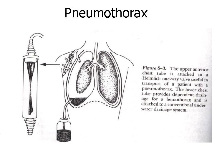 Pneumothorax 