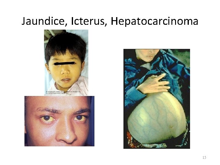 Jaundice, Icterus, Hepatocarcinoma 15 