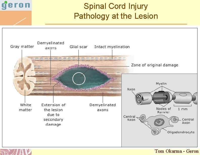 Spinal Cord Injury Pathology at the Lesion Tom Okarma - Geron Doug Brutlag 2011
