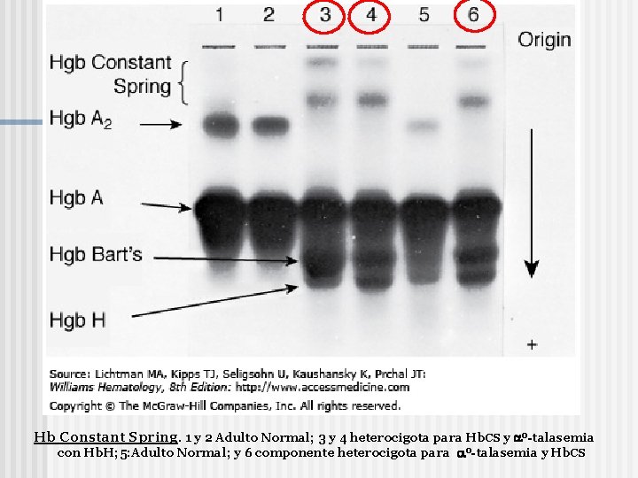 Hb Constant Spring. 1 y 2 Adulto Normal; 3 y 4 heterocigota para Hb.
