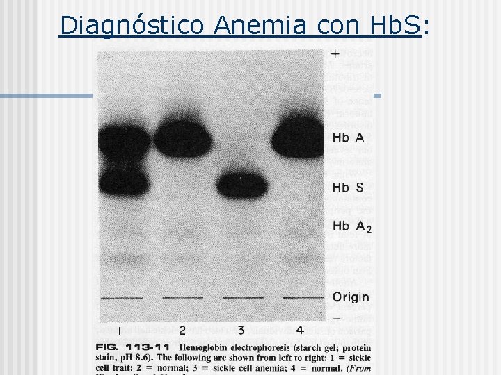  Diagnóstico Anemia con Hb. S: 