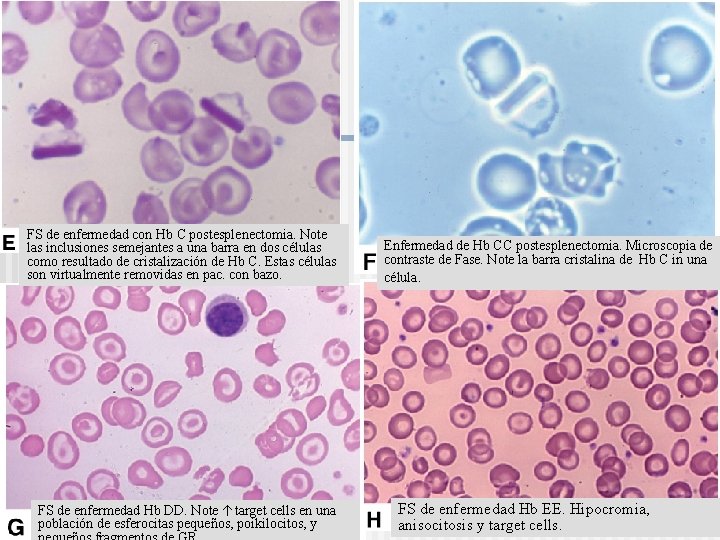 FS de enfermedad con Hb C postesplenectomia. Note las inclusiones semejantes a una barra