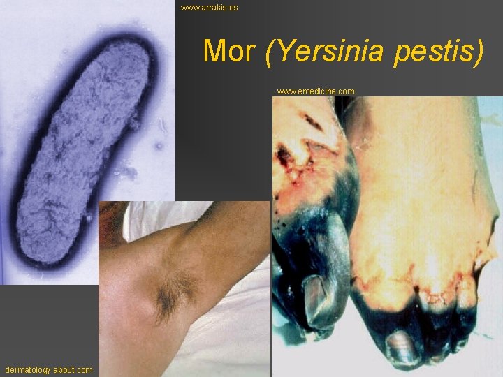 www. arrakis. es Mor (Yersinia pestis) www. emedicine. com dermatology. about. com 