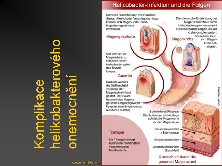 www. medizin. de Komplikace helikobakterového onemocnění 