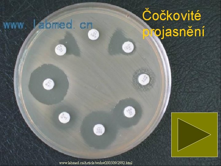 Čočkovité projasnění www. labmed. cn/Article/wshw/200509/2992. html 