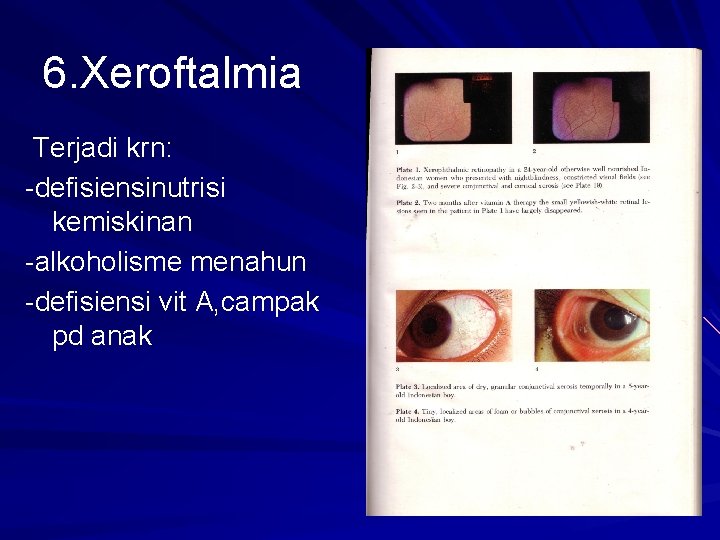 6. Xeroftalmia Terjadi krn: -defisiensinutrisi kemiskinan -alkoholisme menahun -defisiensi vit A, campak pd anak